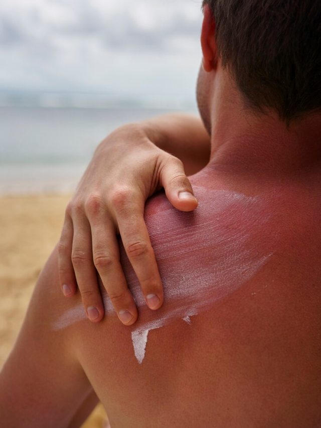 vista-do-homem-aplicando-locao-na-pele-queimada-pelo-sol-na-praia_23-2150282820