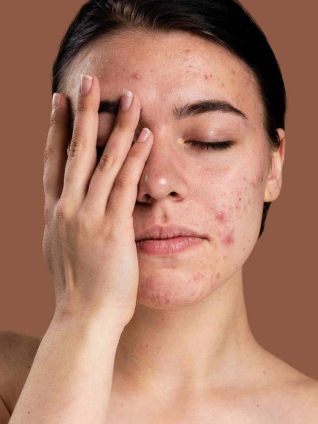 mulher-com-acne-no-rosto-scaled